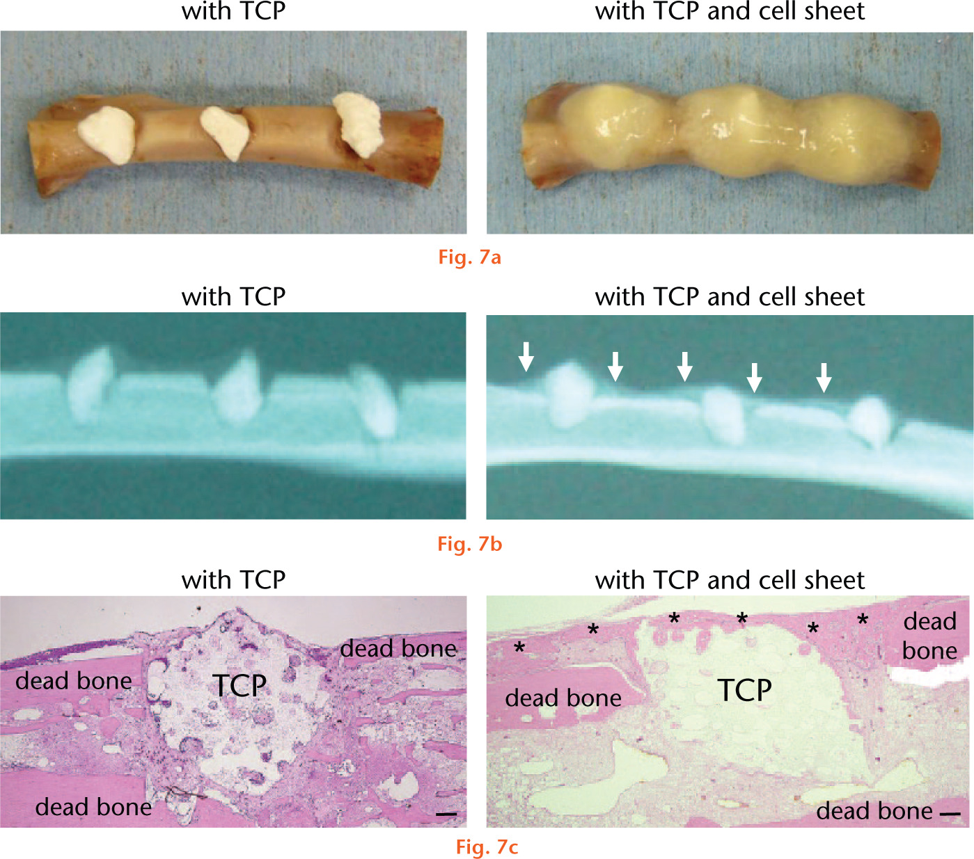  
          Representative images of the dead bone with β- tricalcium phosphate (TCP) samples: a) macroscopic appearance before transplantation; b) the radiograph indicates that calcification was observed around β-TCP in the group treated with β-TCP granules combined with the cell sheet; c) haematoxylin and eosin stained sections showed remarkable bridging bone formation between the β-TCP scaffolds and dead bone in the group treated with β-TCP granules and the cell sheet created in dexamethasone/ascorbic acid phosphate The white arrow indicates calcification (*newly formed bone tissue; bar: 200 μm).
        
