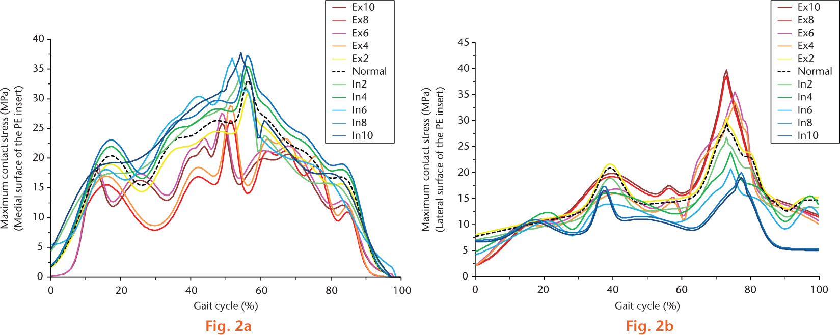  
            Effects of malrotation on the femoral components in total knee arthroplasty with respect to maximum contact stress on the polyethylene insert under gait cycle loading conditions.
          