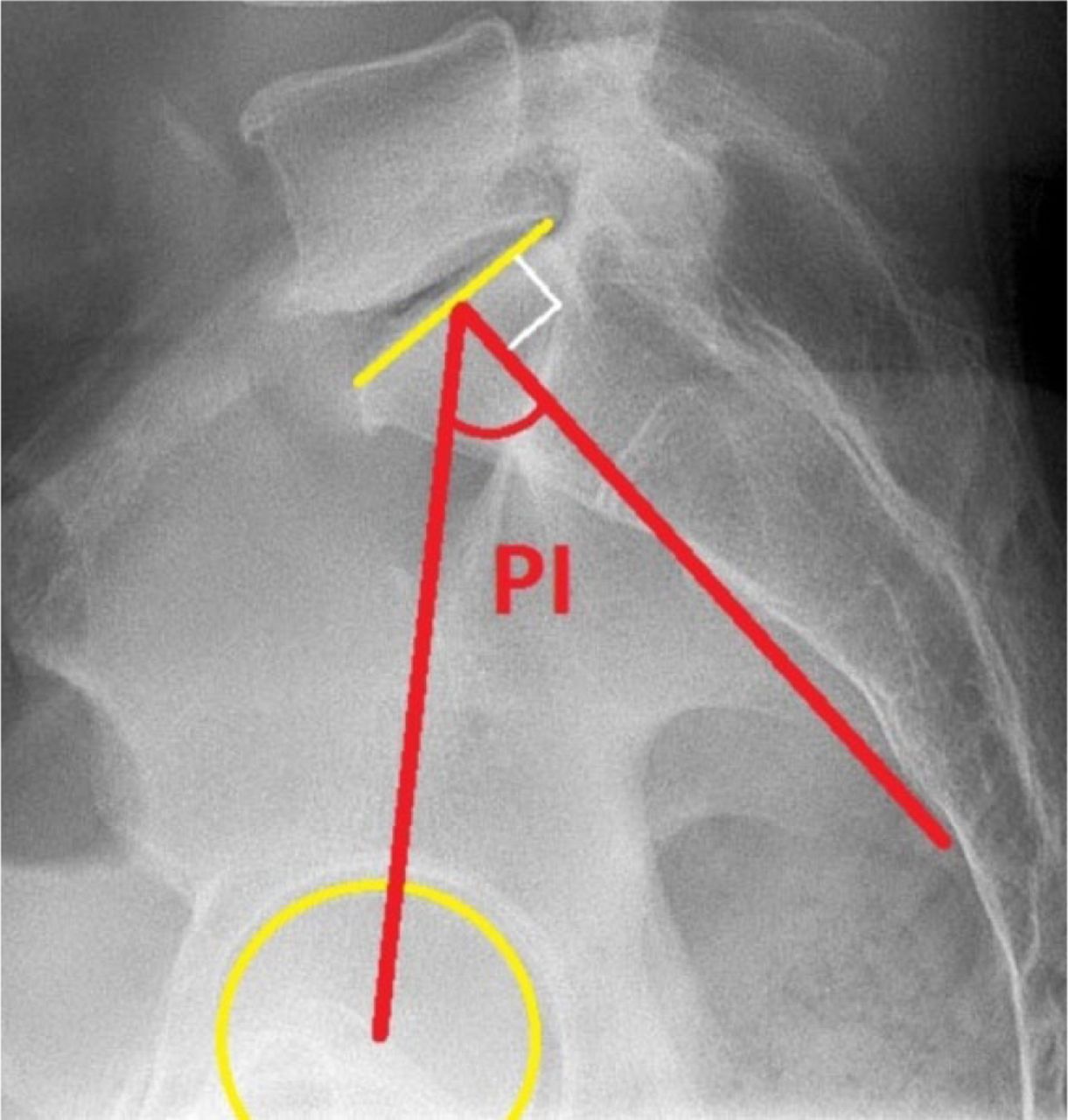 Fig. 1 
          Radiograph showing an example of radiographic measurement of pelvic incidence obtained clinically from a lateral radiograph of the lumbosacral spine.
        