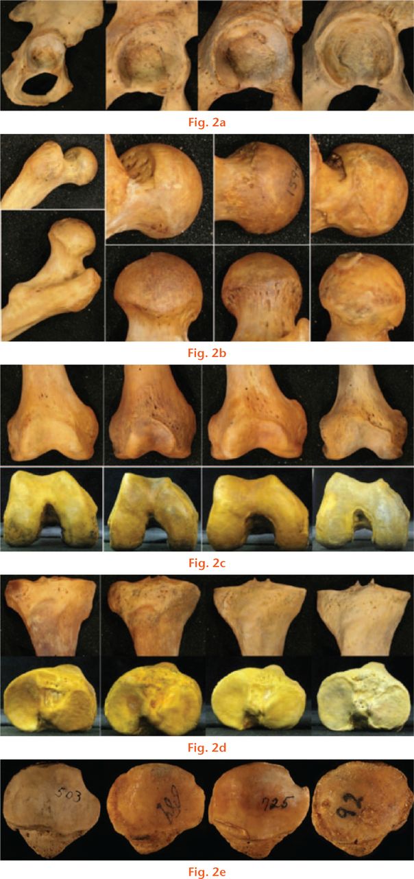  
            Photographs showing examples of a) acetabulum specimens (the increase in osteophytic lipping is clearly demonstrated in these images, while more subtle signs are better appreciated on actual specimens); b) proximal femoral specimens; c) distal femoral specimens; d) proximal tibial specimens and e) patellar specimens - all arthritis grades range from zero to three.
          