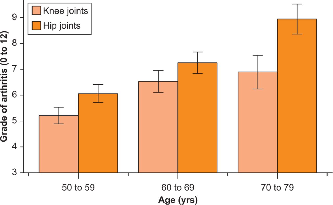 Fig. 4 
          Graph showing the mean and two standard errors for arthritis grading of the knee and hip at ten-year intervals, confirming a strong linear correlation between age and arthritis.
        