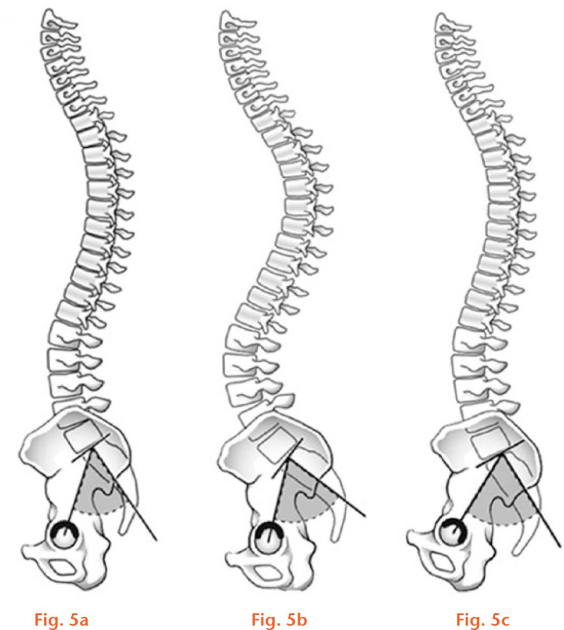  
          Images showing a) normal PI with normal lumbar lordosis; b) increased PI with compensatory increase in lumbar lordosis and c) increased PI with compensatory posterior pelvic tilt and undercovering of the hips.
        