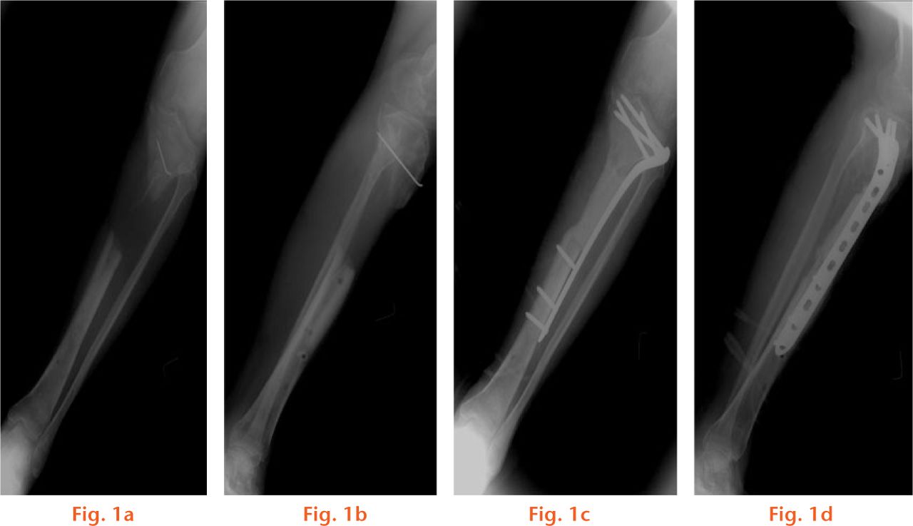  
          Radiographs showing patient 12 - male, 55 yrs, with chronic osteomyelitis for eight months following a car accident. a) and b) pre-operatively, showing left tibial osteomyelitis with bone defect and c) and d), antibiotic bone cement implanted after debridement.
        