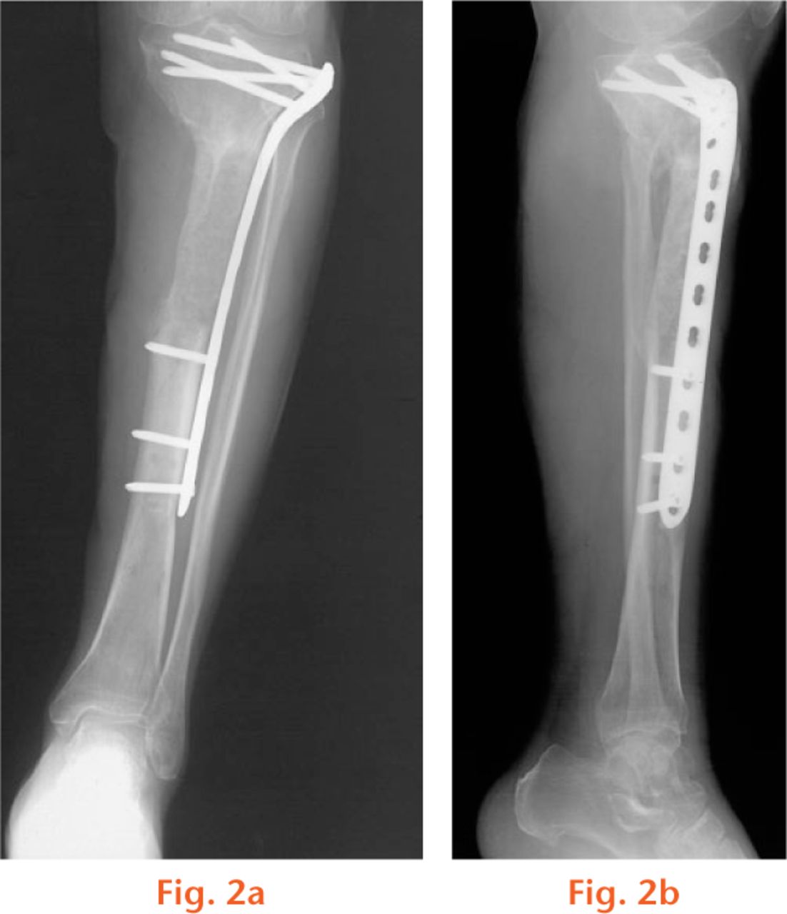  
          Radiographs showing callus formation three months after the grafting.
        