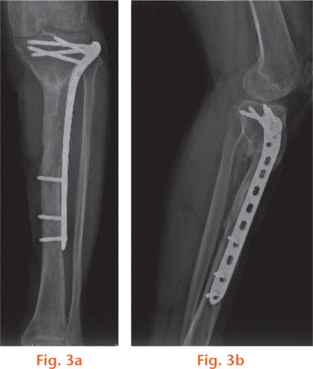  
          Radiographic examination showed bone union 25 months after the second stage.
        