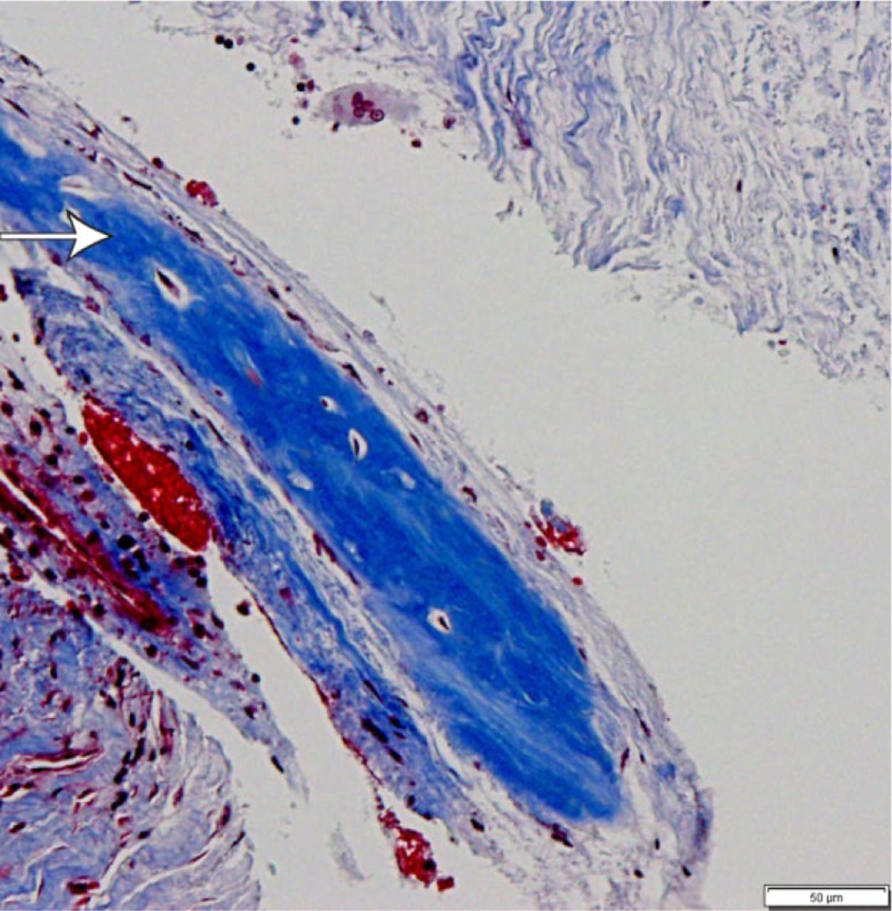 Fig. 1 
            Light microscopic features of the biomembrane tissue. Trabecular bone (arrow) was present in 4/13 (33.3%) of specimens examined for morphological features. (Masson trichrome stain; bar = 50 µm).
          