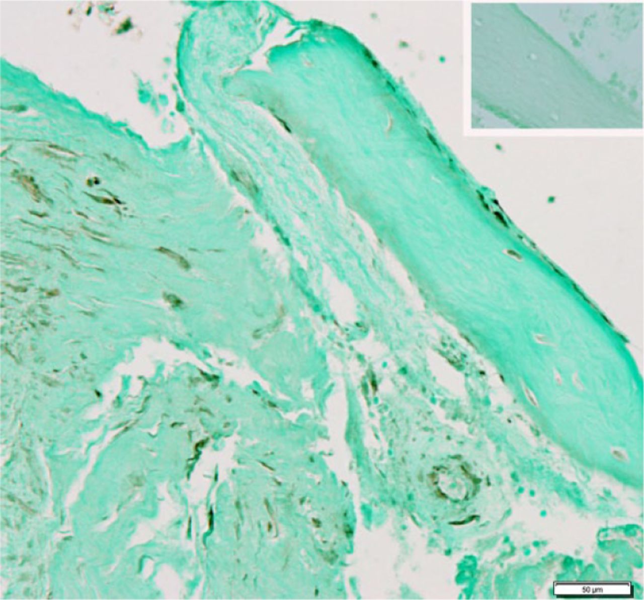 Fig. 3 
            Immunohistochemical localisation of bone morphogenetic protein 2 in the biomembrane. Insert upper right shows an adjacent section processed as a negative control (Bar = 50 µm).
          