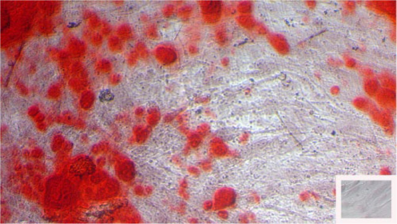 Fig. 5 
            Biomembrane cells cultured in osteogenic differentiation media showed development of calcified nodules as verified here with alizarin red staining. Insert lower right shows no development of calcified nodules in cells grown in control medium. Original magnification ×200.)
          