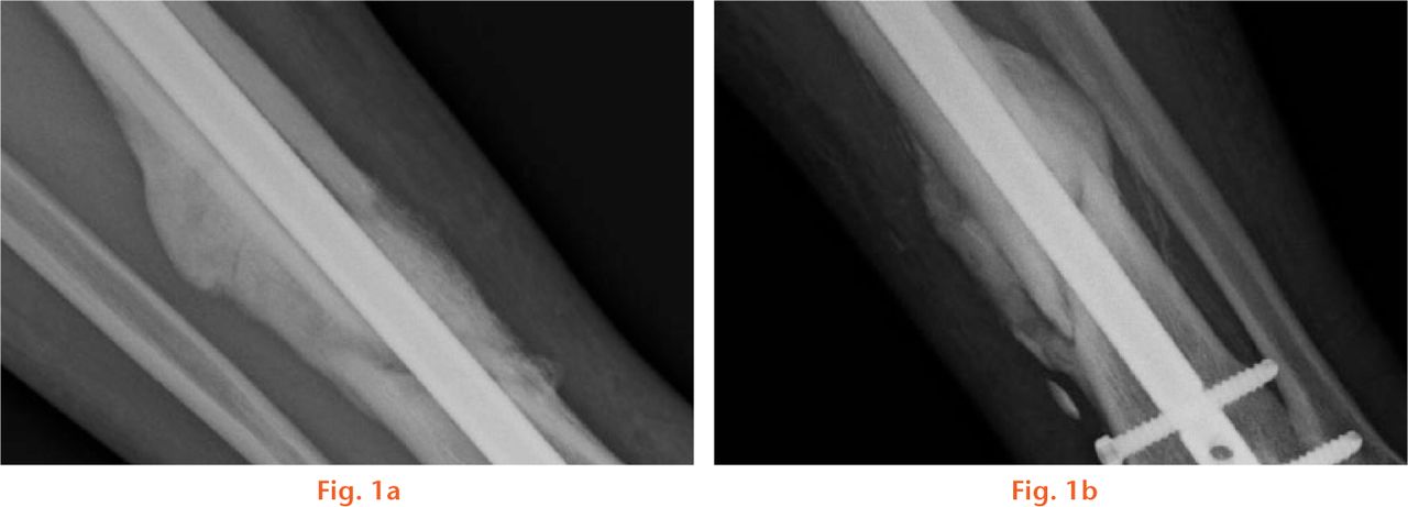  
          Anteroposterior radiographs a) and b) of the tibia and fibula which show bridging callus, yet fracture lines can still be seen between the original cortices.
        