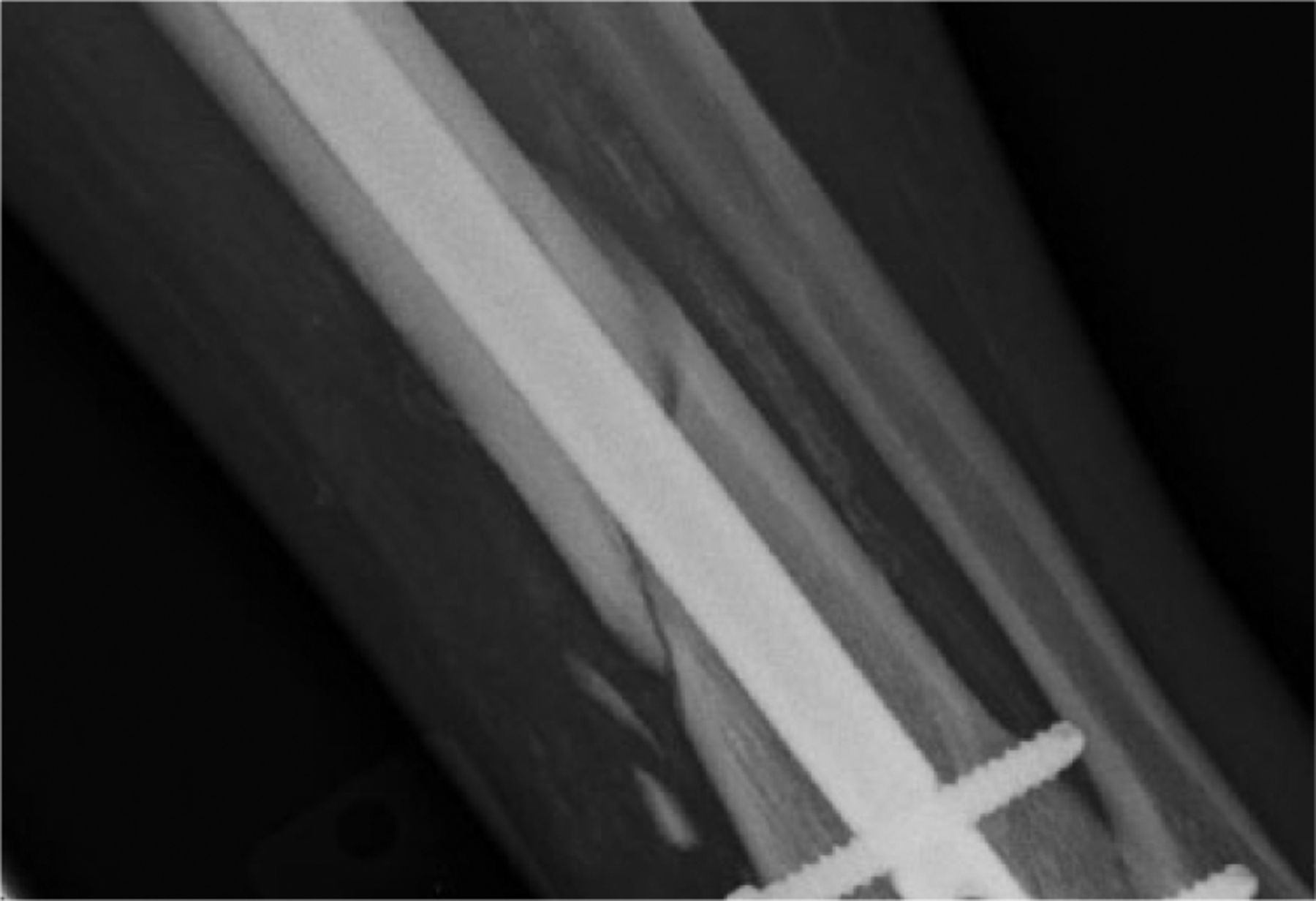 Fig. 4 
          This anteroposterior radiograph of the tibia and fibula may seem to have formation of callus around the lateral cortex despite being taken immediately post-operation. The appearance of bridging bone is due to the spiral pattern and slight displacement, where in fact no callus has yet to form.
        