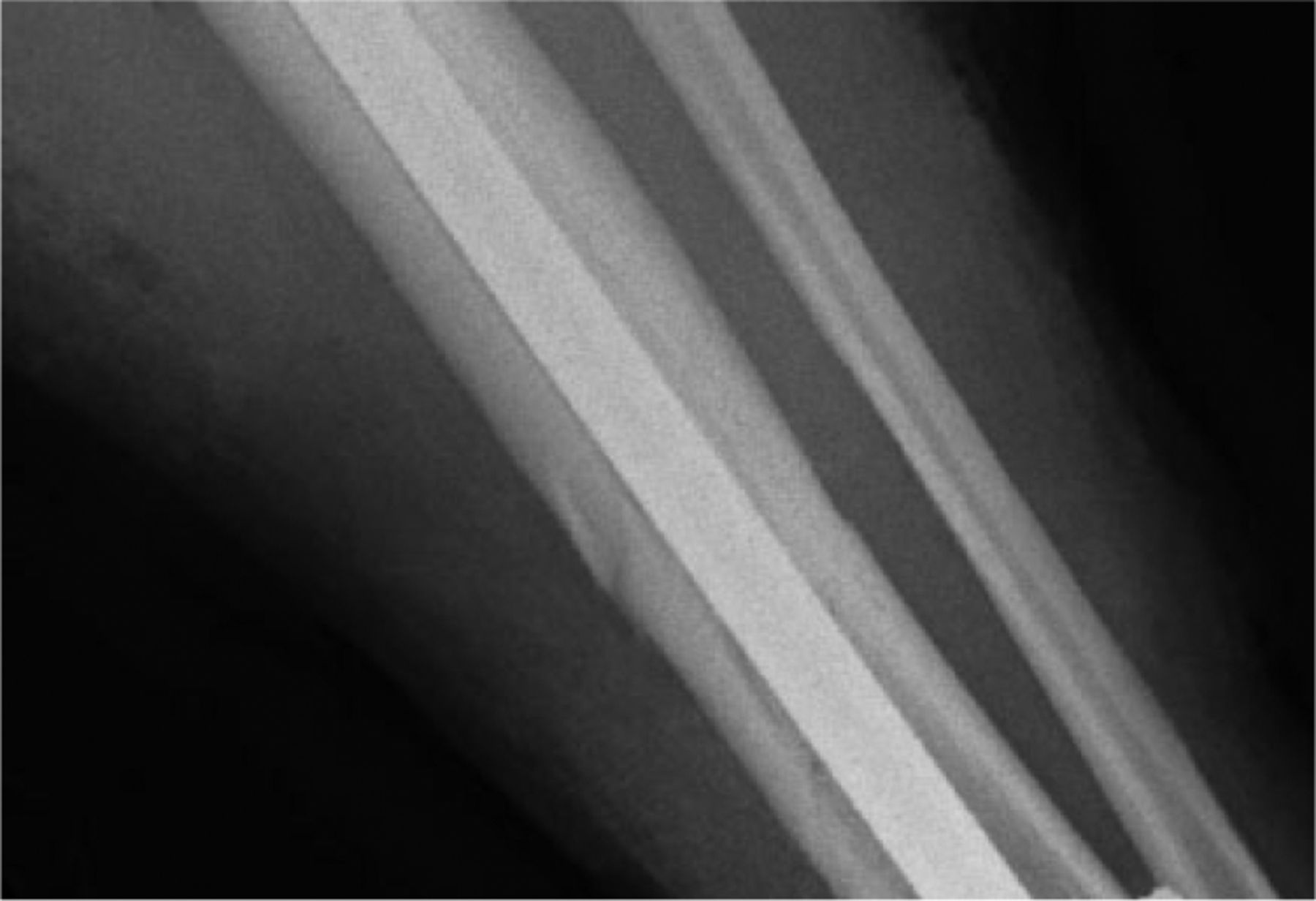 Fig. 5 
          Anteroposterior radiograph showing the tibia and fibula. It was taken immediately after operation and shows barely visible fracture lines, but no callus.
        