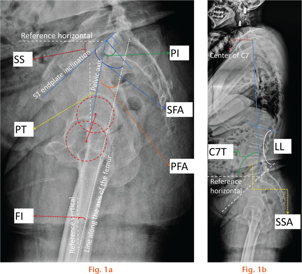  
            Illustration of the radiographic parameters of the sagittal alignment of the spine, pelvis and hip: a) parameters of the pelvis and hip joint. PI, pelvic incidence; PT, pelvic tilt; SS, sacral slope; PFA, pelvic femoral angle; SFA, sacrofemoral angle; FI, femoral inclination; b) parameters of the spine. LL, lumbar lordosis; C7T, C7 tilt; SSA, spinosacral angle.
          
