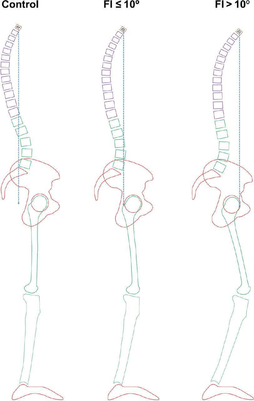 Fig. 3 
          Pattern of compensation in patients with knee osteoarthritis (KOA) with different severities of knee flexion. In normal subjects, the C7 plumb line would pass through or behind the S1 vertebral body, and the anterior pelvic plane would be vertical to the horizontal plane. In patients with KOA and mild knee flexion (FI ⩽ 10°), the femur is posteriorly inclined. To compensate for the disturbed sagittal balance, patients would extend the lumbar spine, showing decreased LL and forward inclined spine. When the knee flexion becomes severe (FI > 10°) and the sagittal balance cannot be compensated by lumbar spine only, the compensation in the sagittal plane is achieved by hip flexion, pelvic anteversion and forward inclination of the spine.
        
