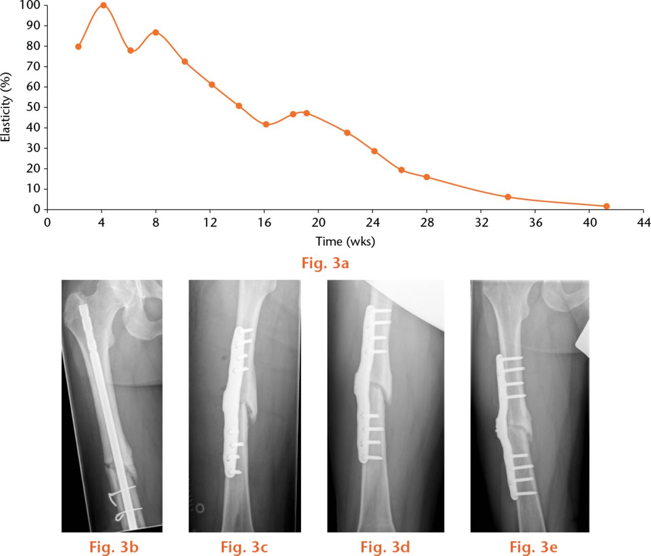  
          Example of a slow healing nonunion. A 33-year-old patient was treated with the instrumented internal fixator for a nonunion 15 months after primary osteosynthesis with a T2 femoral nail and 12 months after dynamisation. In this graph, (a) the curve of the telemetrically measured elasticity of the osteosynthesis, anteroposterior radiographs (b) pre-operatively with a nail inserted, (c) immediately post-operatively, (d) 13 weeks post-operatively, (e) and 32 weeks post-operatively are shown.
        