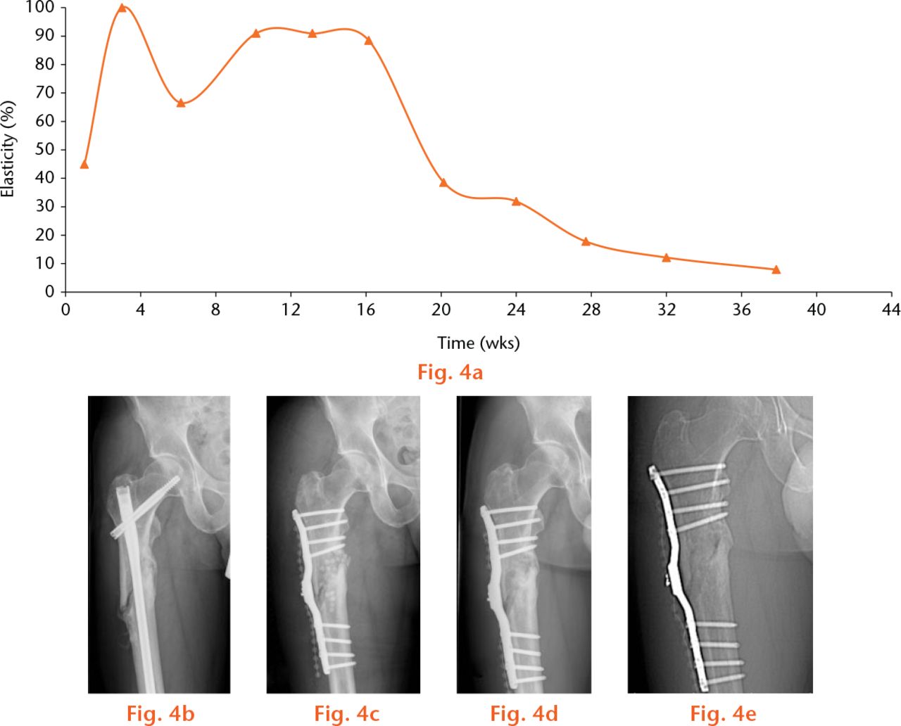  
          Example of a ‘plateau’ healing nonunion. A 43-year-old patient was treated with the instrumented internal fixator for a nonunion 12 months after primary osteosynthesis with a gamma nail, followed by a revision four weeks later because of a 20° torsional deformity. In this graph, (a) the curve of the telemetrically measured elasticity of the osteosynthesis anteroposterior radiographs (b) pre-operatively with a nail inserted (c), immediately post-operatively, (d) 26 weeks post-operatively (e) and 32 weeks post-operatively are shown.
        