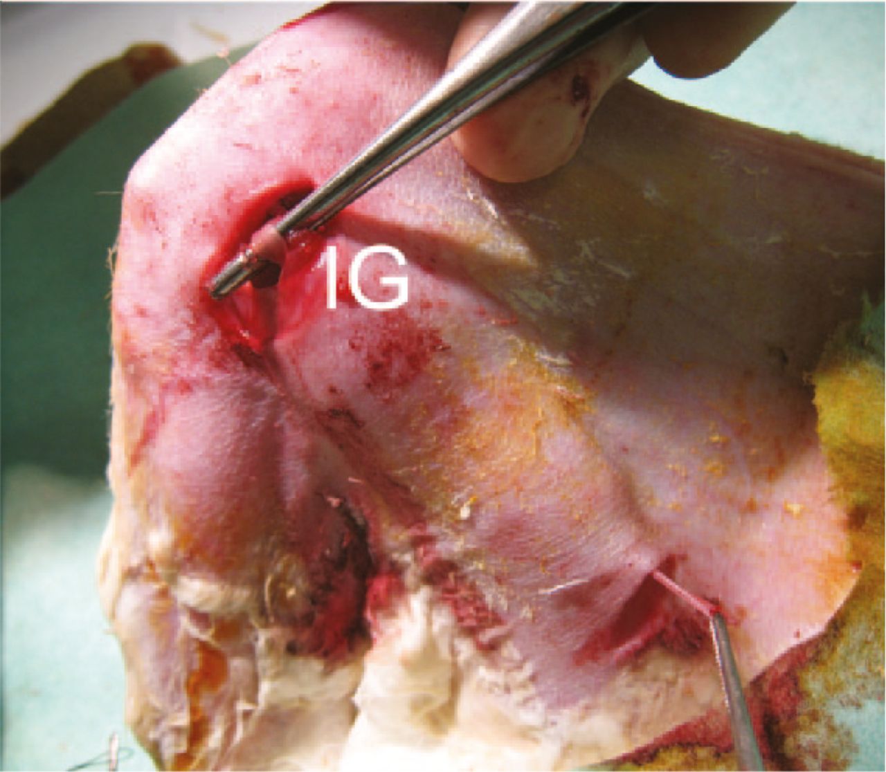 Fig. 2 
          Image of the fascia lata inducing graft (IG) placed into the tendon canal after harvesting the semitendinosus tendon.
        