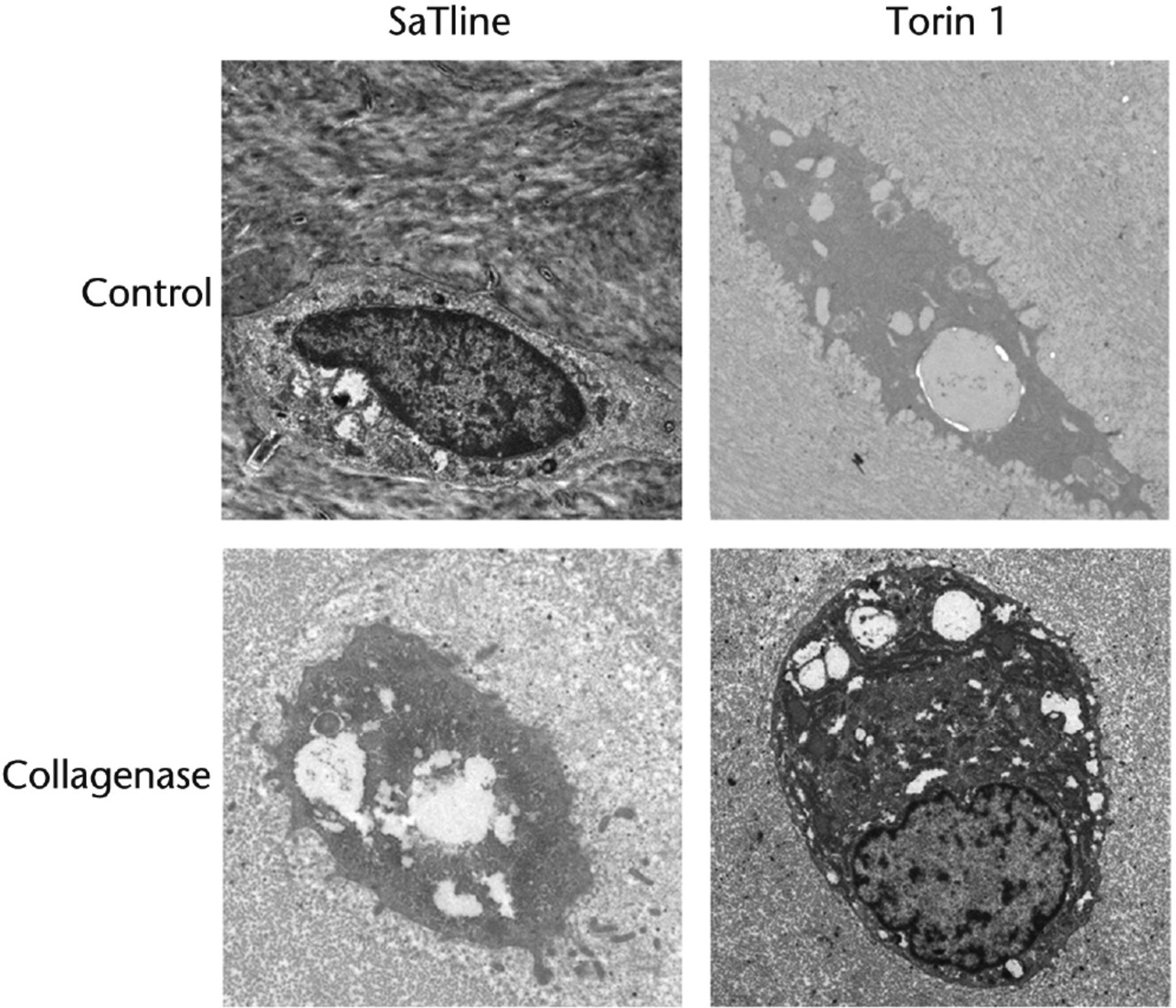 Fig. 2 
            TEM observation. Many more autophagic vacuoles were observed in chondrocytes from Torin 1-treated rabbits than from saline-treated rabbits. In control rabbits treated with saline or Torin 1, chondrocytes located in the lacunae contained autophagic vesicles and were not degenerated. In addition, Golgi apparatus and abundant rough endoplasmic reticulum (RER) were also observed. Chondrocytes from saline-treated rabbits were condensed with absent nuclei and several autophagosomes in the cytoplasm at eight weeks after collagenase injection, and some cell debris were seen in the lacunae. In contrast, chondrocytes from Torin 1-treated rabbits had nuclei and condensed chromatin at eight weeks after collagenase injection (Bar, 1μm).
          