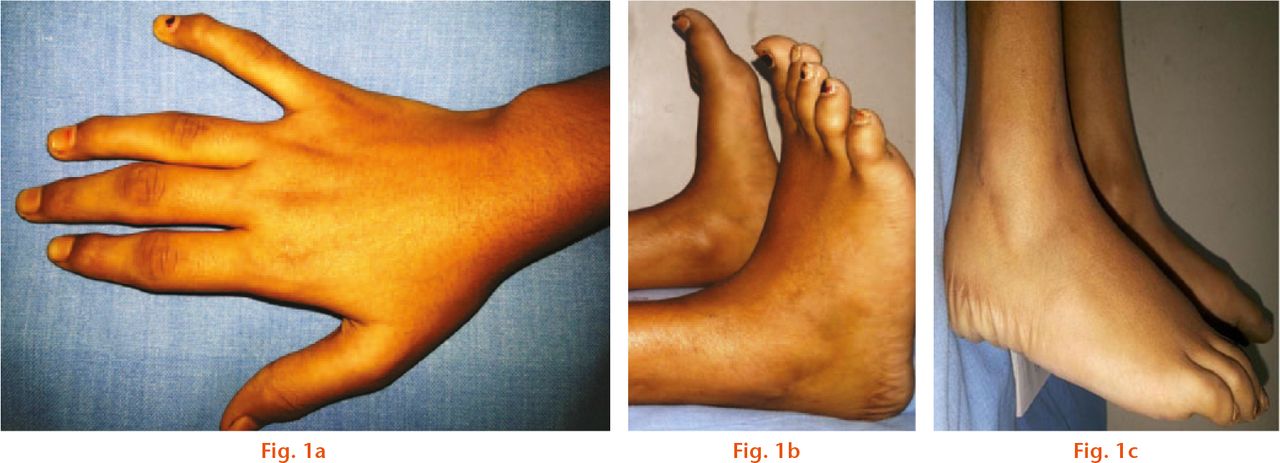  
          Clinical photographs of a 13-year-old girl, which show that a) unique to PPD, the limitation of ankle movement is mainly in plantar flexion; b) classical epiphyseal swelling of the interphalangeal joints with stiffness but without pain is seen in the same patient; c) the same patient shows an enlarged posterior process of the talus which appears early and fuses before ten years of age.
        