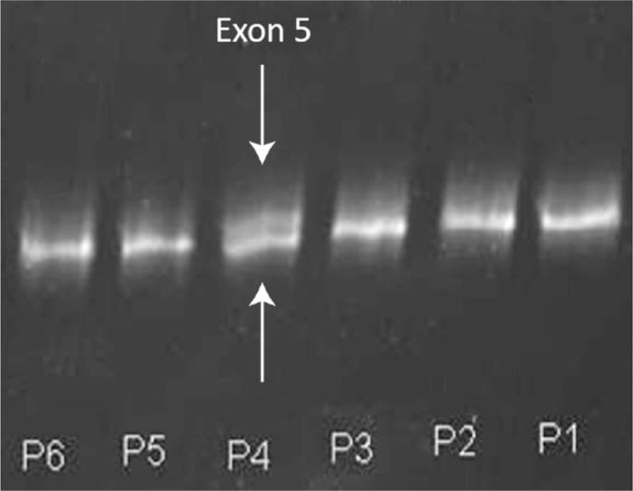 Fig. 3 
          Conformation-sensitive gel electrophoresis for six patients. The fourth patient (P4) shows a heteroduplex band indicated by the white arrow above the normal band of exon 5 (white arrow), indicating a mutation in the fifth exon of the WISP3 gene.
        