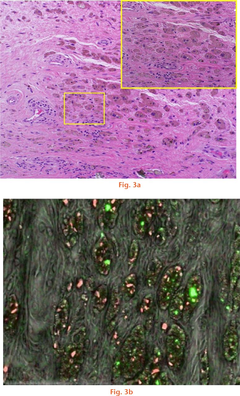  
            A histological section that has a) foreign particles embedded within the tissue. The foreign particles of interest are represented as brown-reddish in appearance; and b) a mapped region of the SEM used to identify the elemental species present in the tissue where Cr is shown in red and Ti particles in green.
          