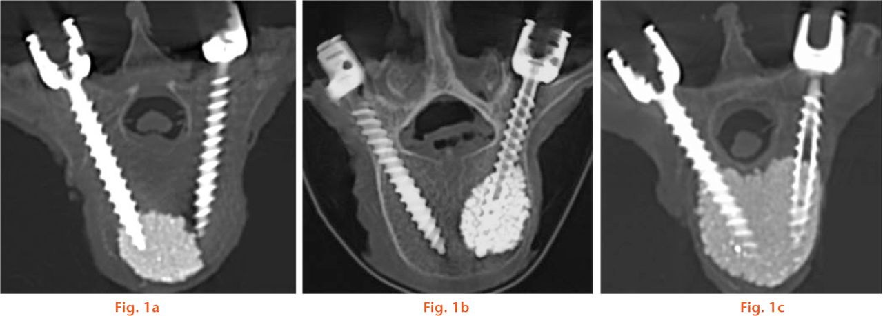  
            CT scans after instrumentation and application of cement (3 mL); a) solid cemented screw (left), showing the far distal location of the cement cloud at the tip of the screw; b) fenestrated cemented screw (right), showing the cement cloud full around the screw, with good anchorage of the screw; and c) two cemented screws, showing the confluence of the cement clouds.
          