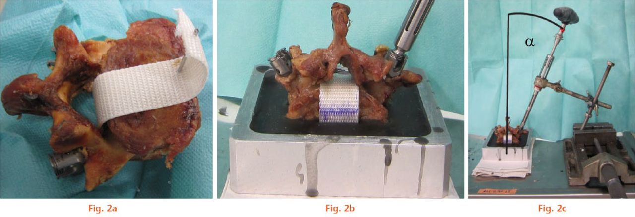  
            Experimental arrangement for mechanical pull-out testing of pedicle screws; a) an inelastic band was wrapped around the vertebral body through the spinal canal and fixed with a Kirschner wire; b) the specimen was embedded in resin up to two thirds of the vertebral body anteroposterior diameter; c) the angle α (angle between the longitudinal screw axis and the vertical embedding axis) was measured in the transverse plane.
          
