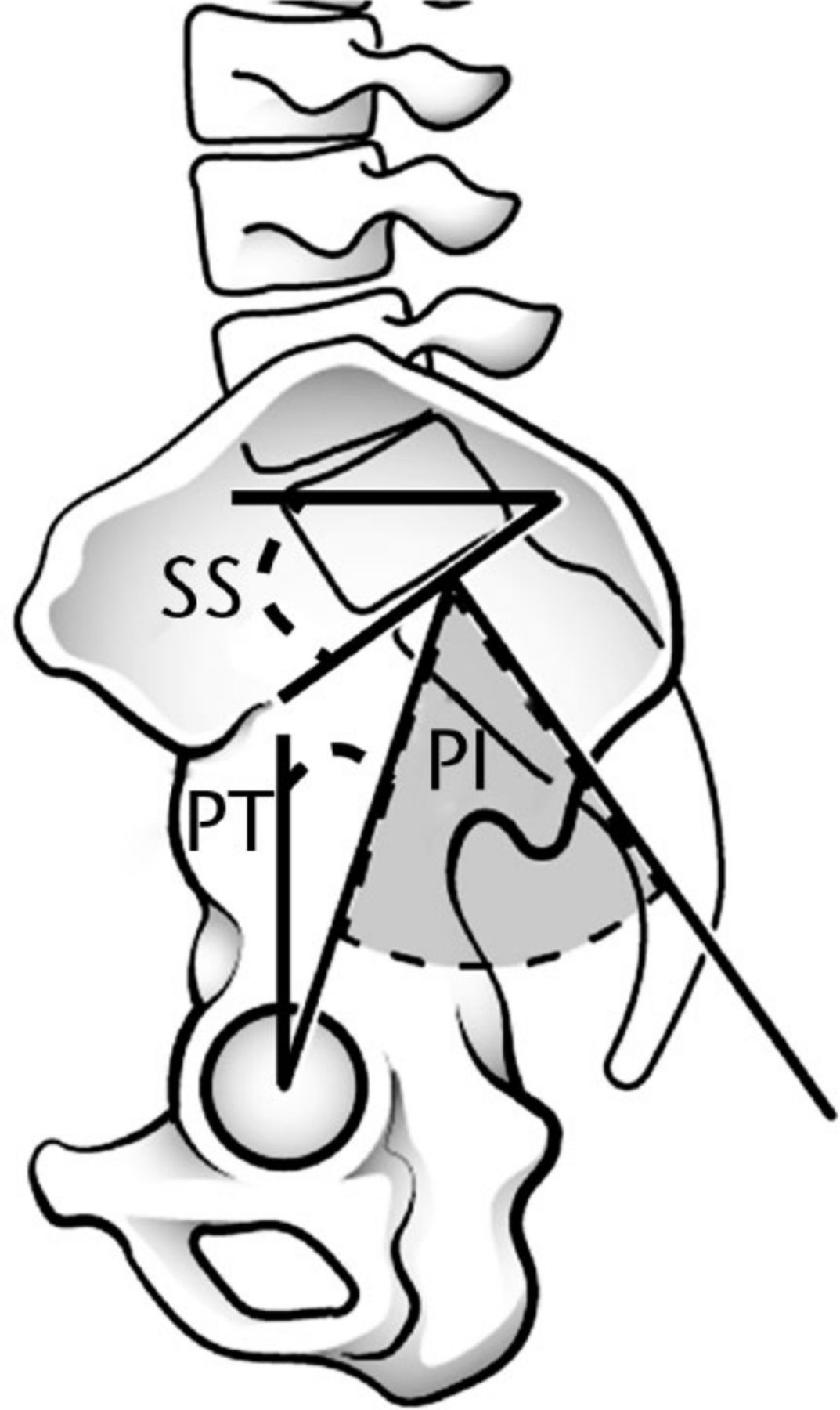 Fig. 1 
          Illustration of a lateral view of the pelvis and lumbar spine demonstrating the non-positional sacropelvic parameter, pelvic incidence (PI), and its positional components, sacral slope (SS) and pelvic tilt (PT). PI is defined as the angle formed between the line perpendicular to the sacral plate at its midpoint and the line connecting this point to the axis of the femoral heads. PT is defined as the angle between the vertical and the line connecting the midpoint of the sacral plate and the femoral axis. SS is defined as the angle between the superior plate of S1 and a horizontal line.
        