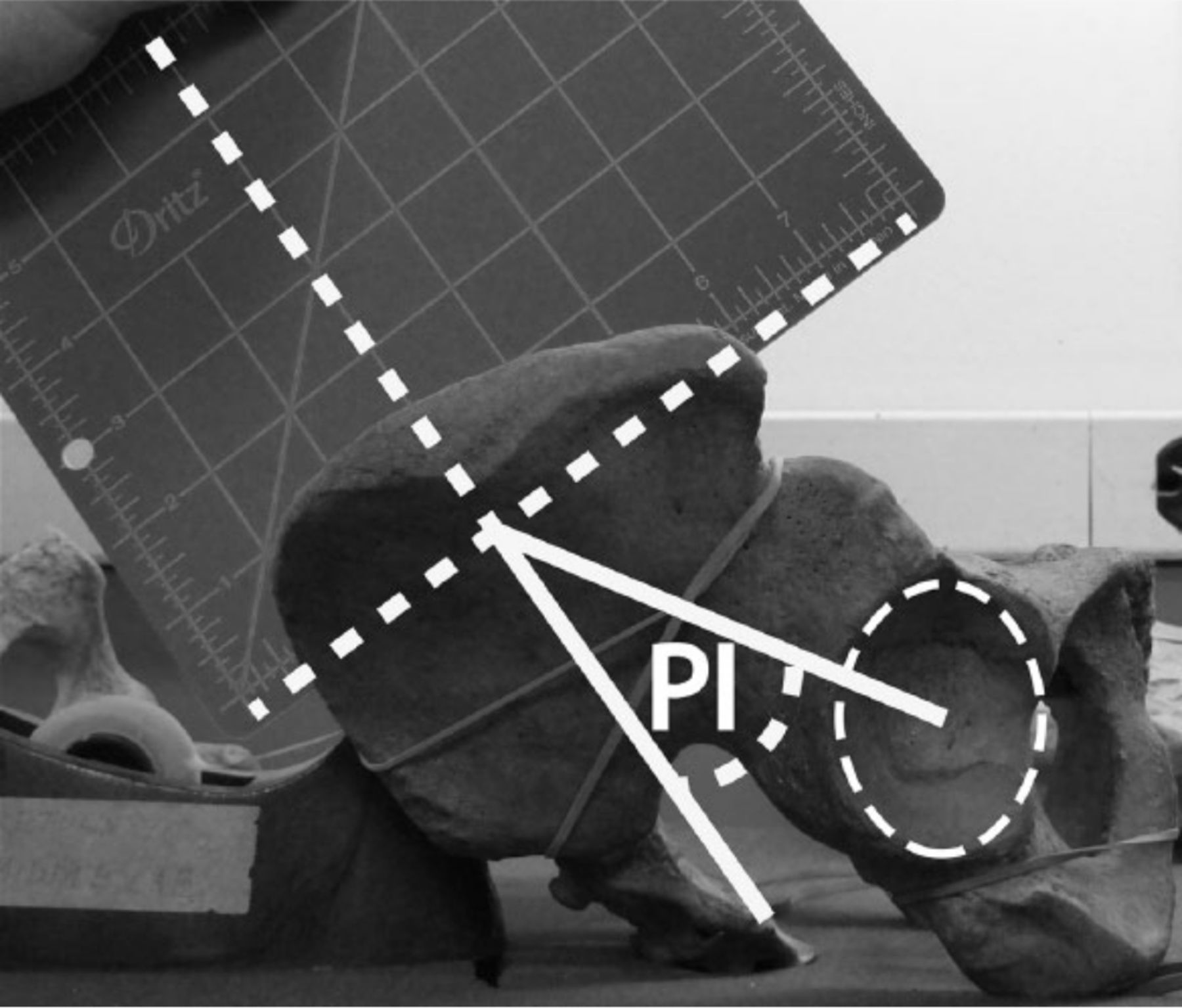 Fig. 3 
          Measurement of pelvic incidence (PI), which was defined as the angle formed between a line perpendicular to the midpoint of the sacral endplate and a line connecting the centre of the sacral endplate and the centre of the best-fit ellipse of the acetabular rim. The best fit ellipse of the acetabular rim serves as a surrogate marker of the femoral head axis.
        