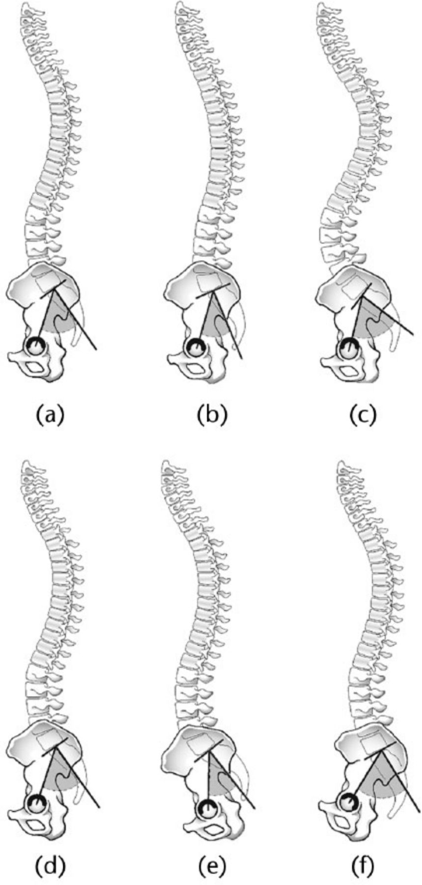 Fig. 5 
          Proposed kinematic mechanism for pelvic incidence influencing hip impingement. Top row: Pelvic orientation and lumbar lordosis corresponding to normal (a), low (b), and high (c) pelvic incidence. Bottom row: Proposed compensatory pelvic tilt in order to maintain appropriate sagittal balance and normalise lumbar lordosis. The pelvis with normal pelvic incidence (d) is static. The pelvises with low (e) and high (f) pelvic incidence normalise their lumbar lordosis through anterior and posterior pelvic tilt, respectively.
        