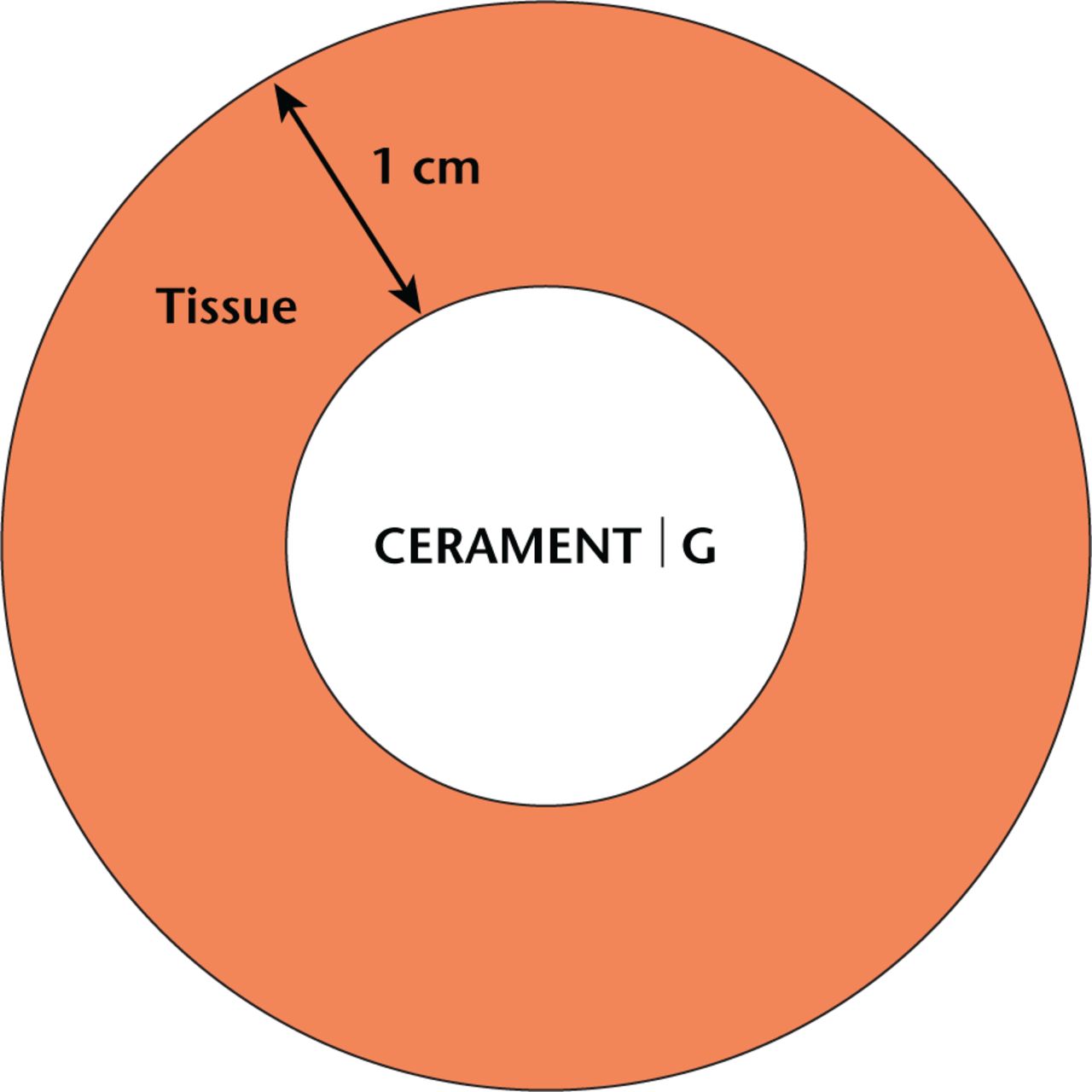 Fig. 1 
            Illustration of the local release model used for the in vitro release test. In an in vivo condition the minimal inhibitory concentration levels for gentamicin-sensitive microorganisms should be reached in all the tissue surrounding the device up to a distance of approximately 1 cm. Since the volume of the implant is 10 mL, the surrounding volume of a distance up to 1.09 cm is approximately 50 mL.
          