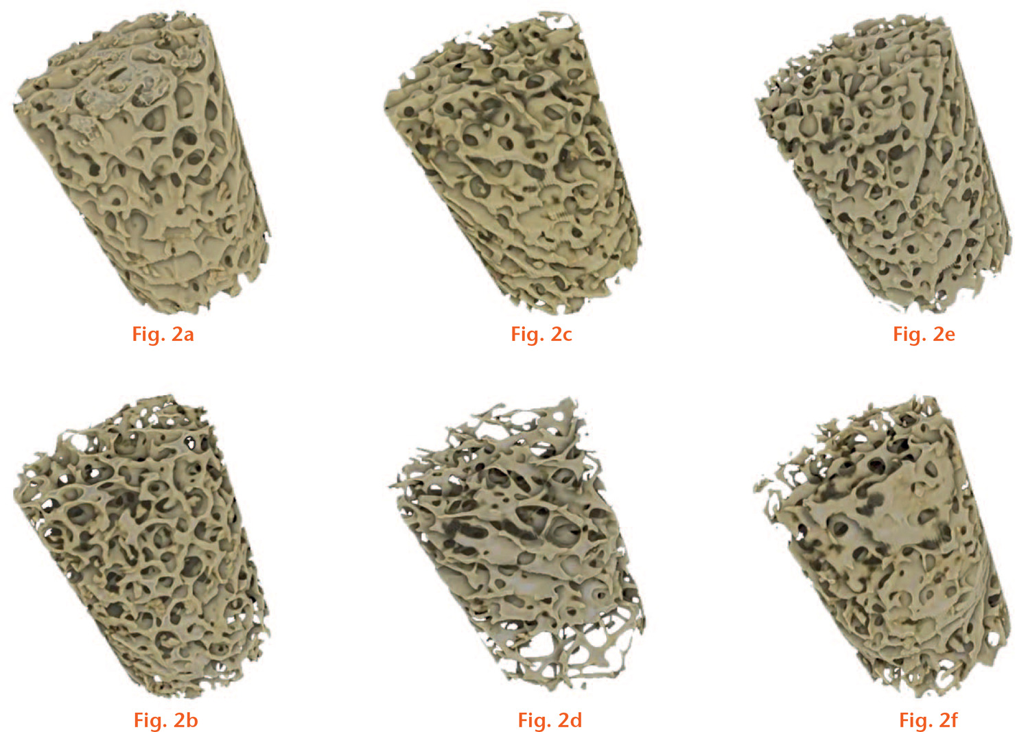  
          Rendered micro-CT images of trabecular bone cores. The top and bottom rows represent cores with the highest and lowest bone volume fraction (BVF) for a) and b) non-fractured; c) and d) untreated fracture patients; and e) and f) BP-treated fracture patients.
        