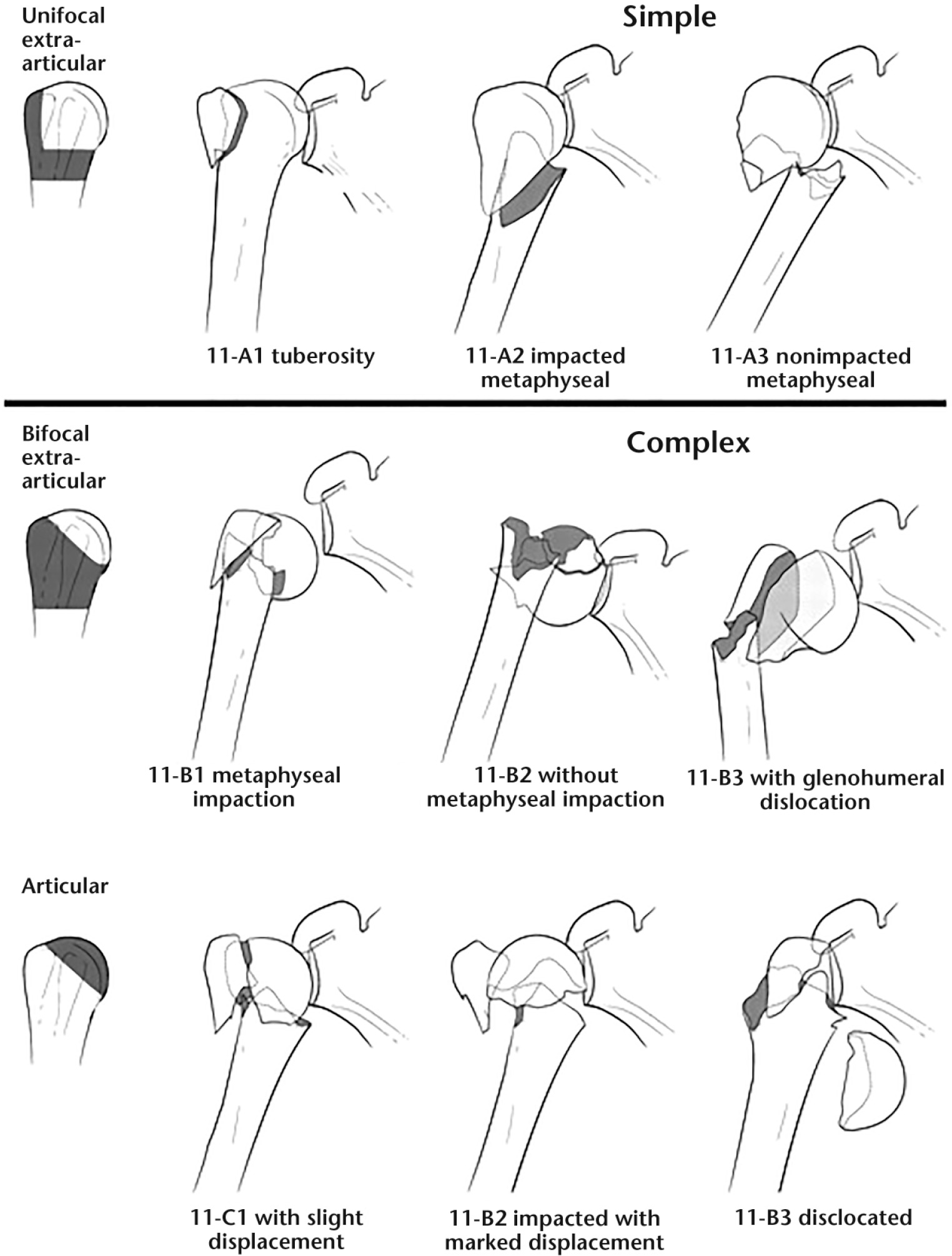 Fig. 2 
            Proximal humeral fractures divided into simple and complex fractures using the AO/OTA criteria.
          