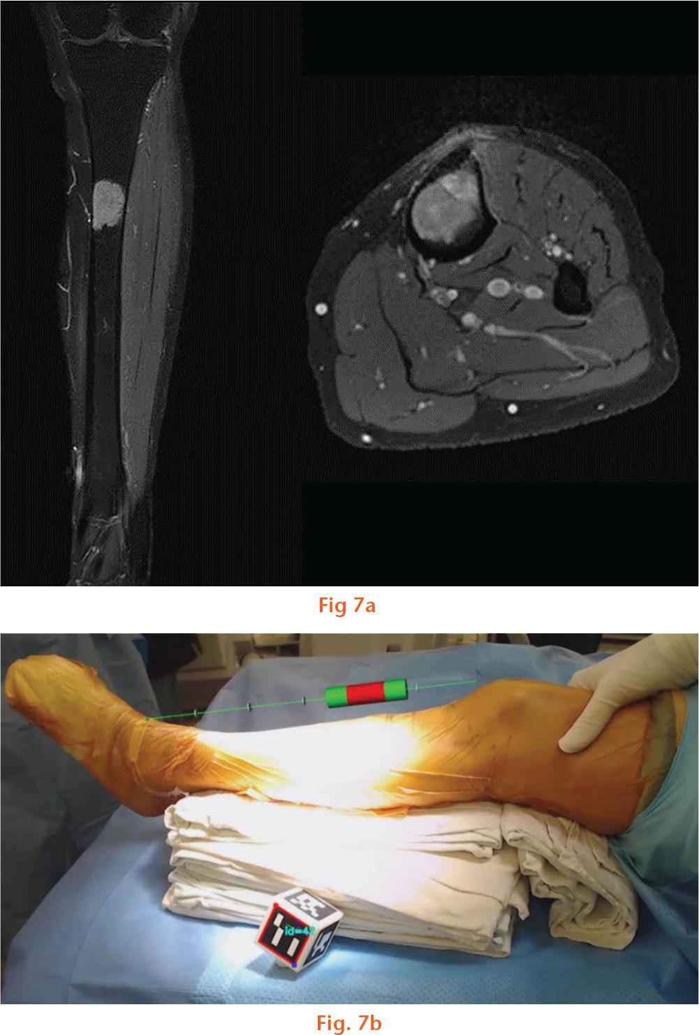  
          Images showing: a) intercalary resection was planned based on MR images and b) how the osteotomies were monitored under augmented reality based navigation guidance.
        