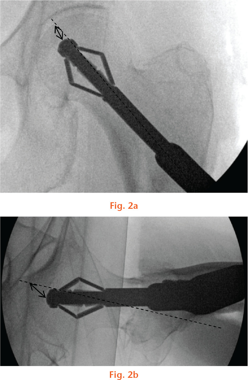  
          Intra-operative radiographs showing measurement of tip-apex distance for the X-Bolt dynamic plating system in anteroposterior (a) and lateral (b) views. The apex of femoral head was defined as the intersection of the central axis of the femoral neck (dashed line) with subchondral bone. Double headed arrows showing tip-apex measurement.
        