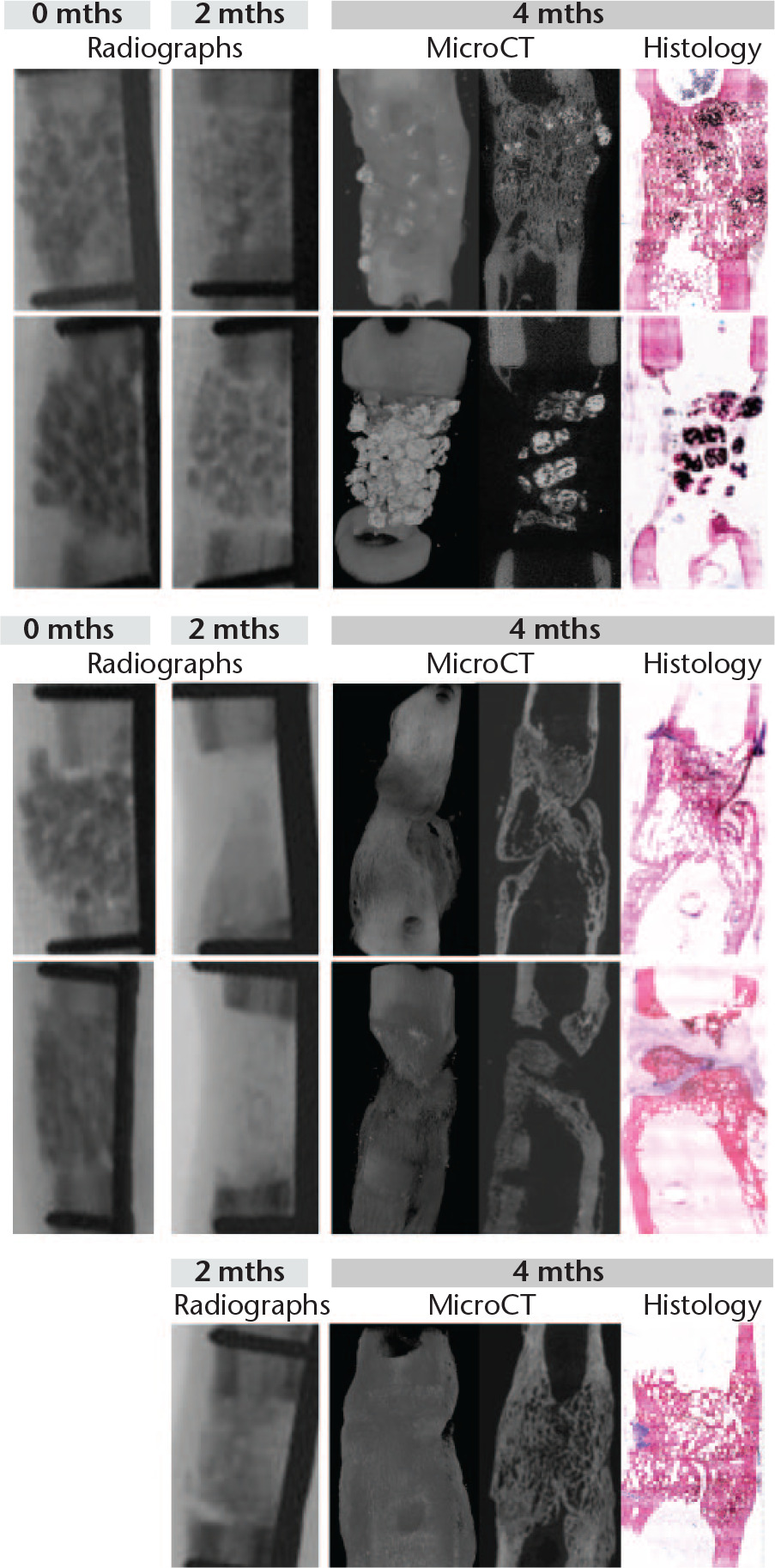 Fig. 2 
            Radiographs after surgery and at two months, CT reconstructions, and histological slides at four months of the metatarsal bone defects of animals implanted with Acropora-tissue-engineered constructs (TEC) a), Porites-TEC b) and autograft c).
            At two months post-operatively, on radiographs, newly-formed bone could not be distinguished from the remaining scaffold material in case of Acropora-TEC (a), but partial to full bioresorption was observed with Porites-TEC (b). At 4 months, full bone regeneration was observed in some animals (a and b top), resembling that observed in autografted animals (c). Recorticalisation was observed in the Acropora-TEC filled defect (a top). In the other animals, new bone formation was limited (a and b bottom). There were still Acropora-TEC present in the defect (a), whereas almost no Porites-TEC remained (b), four months post-operatively. Stains: Stevenel blue and von Gieson picrofuschin. Bone, cells, and coral stained red, blue, and brown, respectively.
          