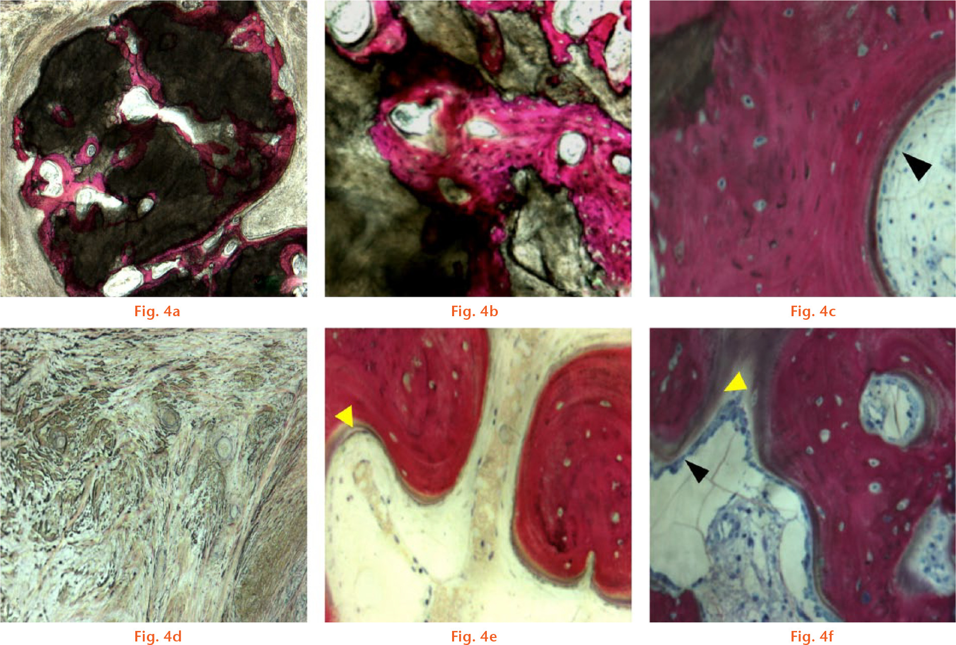  
            Representative histology of newly formed bone in the tested defects. New bone tissue was present above and inside the remaining coral scaffolds (a and b). Both mature and immature bone tissue was observed, with, respectively, well-orientated, small and dark cells (osteocytes in lacunae) forming a lamellar tissue (c and e) and disorganised, large-nucleated cells forming a non-lamellar tissue (b and f). Abundant osteoid (yellow arrow heads) encircled by bone-lining cells (black arrow heads) was present surrounding the bone tissue, revealing active bone formation (c, e and f). When bone tissue was absent, fibrous tissue was filing the defect (d). The images were obtain from two sheep of the Acropora-TEC group.
            Stains: Stevenel Blue and von Gieson picrofuschin. Bone, cells, and coral stained red, blue, and brown, respectively.
          