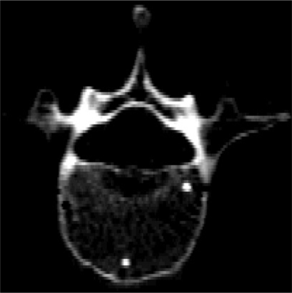 Fig. 2 
            CT image of the spine segment. The white dots are two of the aluminum ball markers.
          