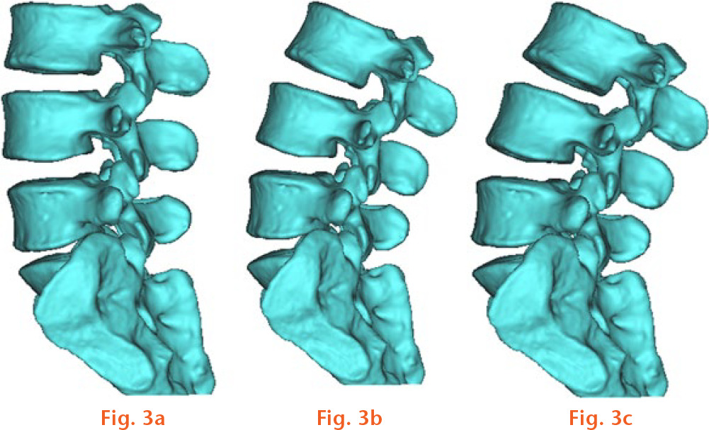  
            Three-dimensional models of the lumbar spine from the CT data from the different positions (a: Flexion, b: Neutral, c: Extension).
          