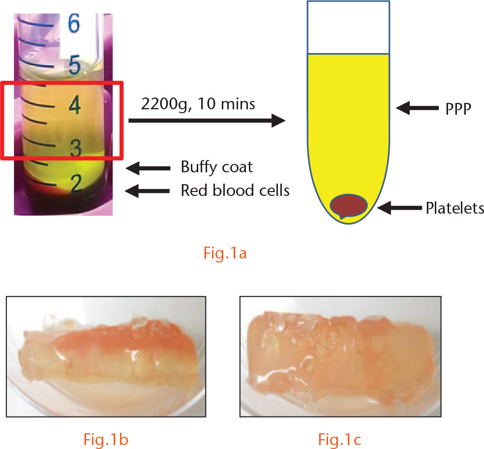  
            Preparation of kartogenin platelet-rich plasma (KGN-PRP) gel and PRP gel. a) Whole blood from each rat used in three experimental groups was separated into three layers after centrifugation at 500 g for ten minutes. A second centrifugation of the supernatant (red box) at 2200 g for ten minutes yielded platelet-poor plasma (PPP) and the platelet pellet. PRP was prepared by re-suspending the platelets in a small volume of PPP and diluted further with PPP, such that the platelet concentration was about three times higher than that found in whole blood. b) A typical KGN-PRP gel made by adding thrombin to a mixture of PRP and KGN. c) A typical PRP gel obtained by adding thrombin to PRP.
          