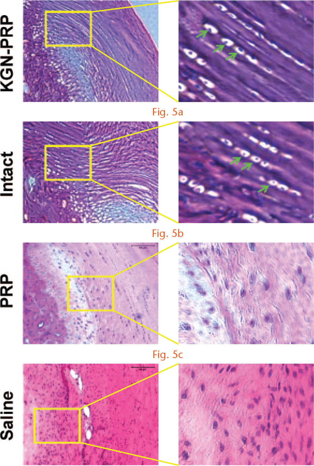  
          Kartogenin-platelet-rich plasma (KGN-PRP) treatment results in well organised collagen fibres in the healing site of wounded rat Achilles tendon entheses (ATE). KGN-PRP-treated ATE (a) shows well organised arrangement of collagen fibres; moreover, mature chondrocytes that align with collagen fibres are present in the transition zone between tendon and bone (arrows), which are similar to those of intact rat ATEs (b). The PRP-treated ATE (c) has less organised collagen fibres; and saline-treated ATE (d) reveals defects in the healed ATE evidenced by gaps. In both PRP and saline groups, formation of chondrocytes is not apparent, and cell organization is also random.
        
