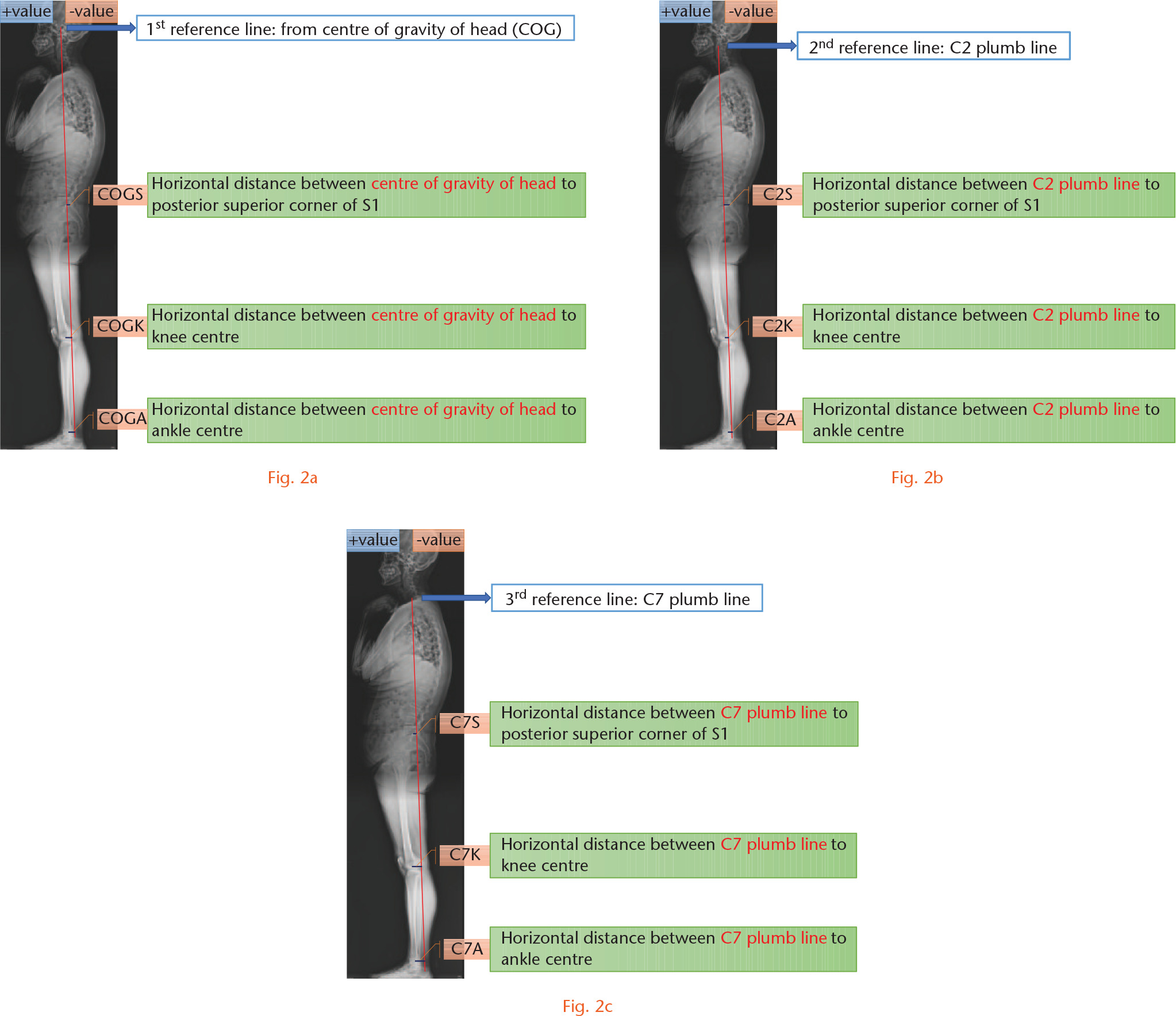  
            Lateral whole-body radiograph: parameters from a) centre of gravity of head (COG); b) C2 plumb line; and c) C7 plumb line.
          