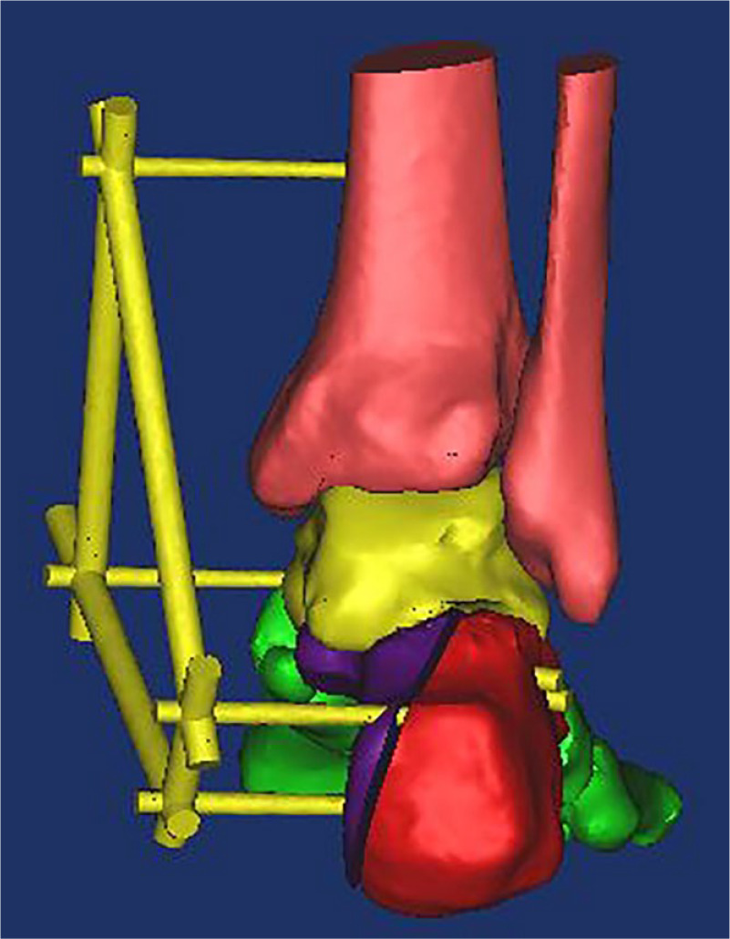 Fig. 1 
            The CAD model of the EFLIF for Sanders type 2 calcaneal fractures.
          