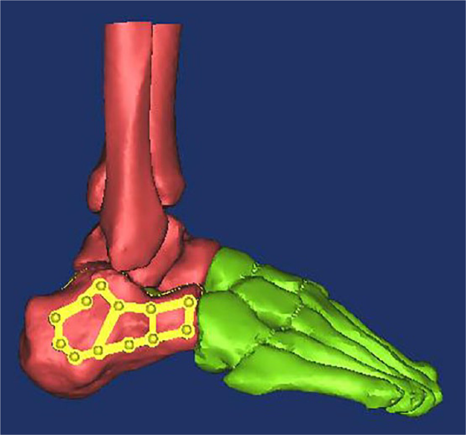 Fig. 2 
            The CAD model of the plate for Sanders type 2 calcaneal fractures.
          