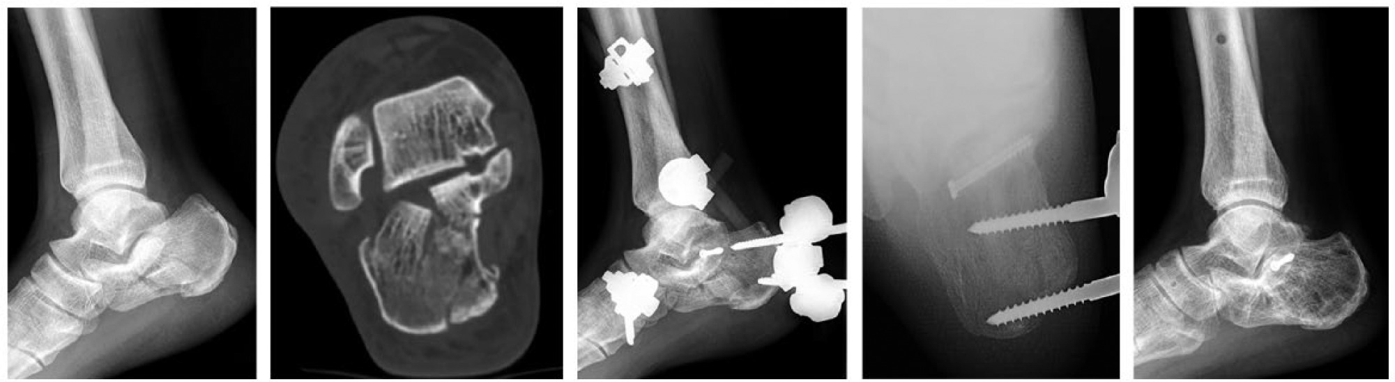 Fig. 6 
            A patient with Sanders type 2 calcaneal fractures treated with EFLIF. From left to right: a) pre-operatively in the lateral view; b) CT pre-operatively; one week post-operatively in the c) lateral and d) axial view; and e) one year post-operatively in the lateral view.
          