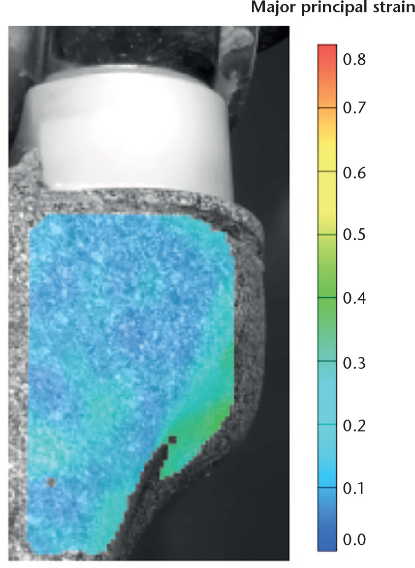Fig. 8 
          Anterior Digital Image Correlation image of a standard implant position bone loaded at 1.5 kN, demonstrating that the highest strains are being delivered onto the anterior cortex 2 cm to 3 cm distal to the implant.
        
