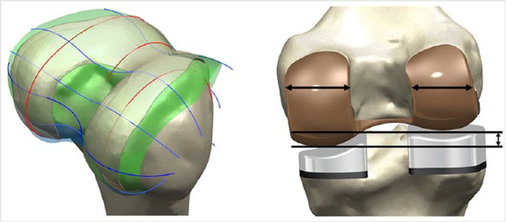 Fig. 1 
          Procedure for patient-specific total knee arthroplasty (TKA) design in a) patient’s anatomical ‘J’ and spline curves, and b) restoration of the patient’s medial and lateral joint lines and condylar offsets in femoral component and corresponding polyethylene insert.
        