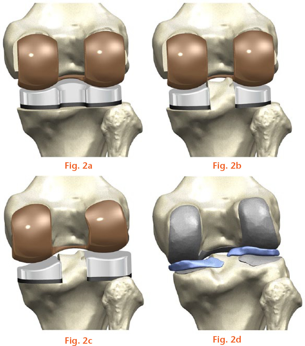  
            FEM used in analysis: a) standard off-the-shelf cruciate-retaining total knee arthroplasty (TKA); b) standard off-the-shelf bicruciate-retaining TKA; c) patient-specific bicruciate-retaining TKA; d) normal adult knee.
          