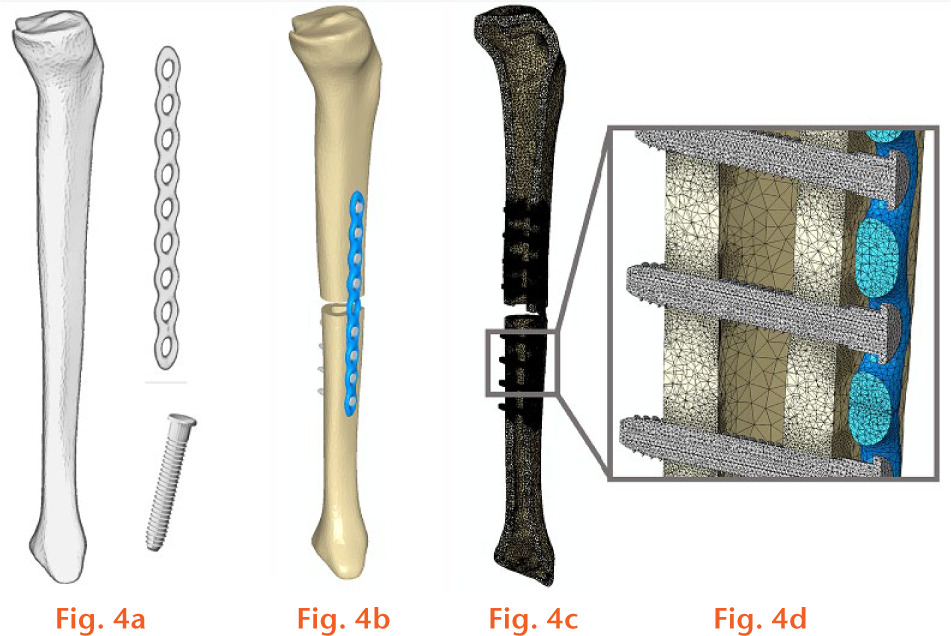  
            a) 3D geometries of the composite tibia, plate, and screws; b) the finite element model; c) the meshed model; and d) the mesh resolution at the screw-bone interface.
          