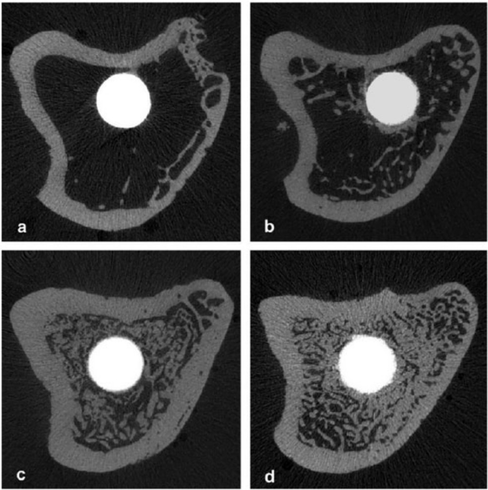 Fig. 2 
          Micro-CT representative images. Representative micro-CT images of tibias three months after implantation: a) control, b) pamidronate-treated, c) ibandronate-treated, and d) zoledronate-treated groups. Reproduced from Gao Y, Zou S, Liu X, Bao C, Hu J. The effect of surface immobilized bisphosphonates on the fixation of hydroxyapatite-coated titanium implants in ovariectomized rats. Biomaterials 2009;30:1790–1796 (with permission from Elsevier).
        