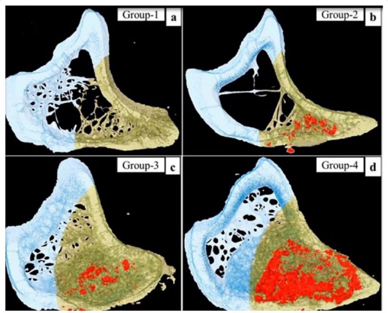 Fig. 3 
          
            Ex vivo micro-CT reconstructions in the tibia defect model. Representation of extensive bone formation (red colour) using zoledronate (0.2 mM) compared with bioactive protein fraction derived from Saos2 cell lines. (a) Group 1 (control), (b) Group 2 (gelatin-cement), (c) Group 3 (gelatin-cement + Saos2 fraction), (d) Group 4 (gelatin-cement + ZA). Reproduced from Teotia AK, Gupta A, Raina DB, Lidgren L, Kumar A. Gelatin-modified bone substitute with bioactive molecules enhance cellular interactions and bone regeneration. ACS Appl Mater Interfaces 2016;8:10775–10787 (with permission from the publisher; American Chemical Society).
        